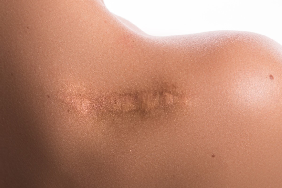 Sublime Aesthetic Scars