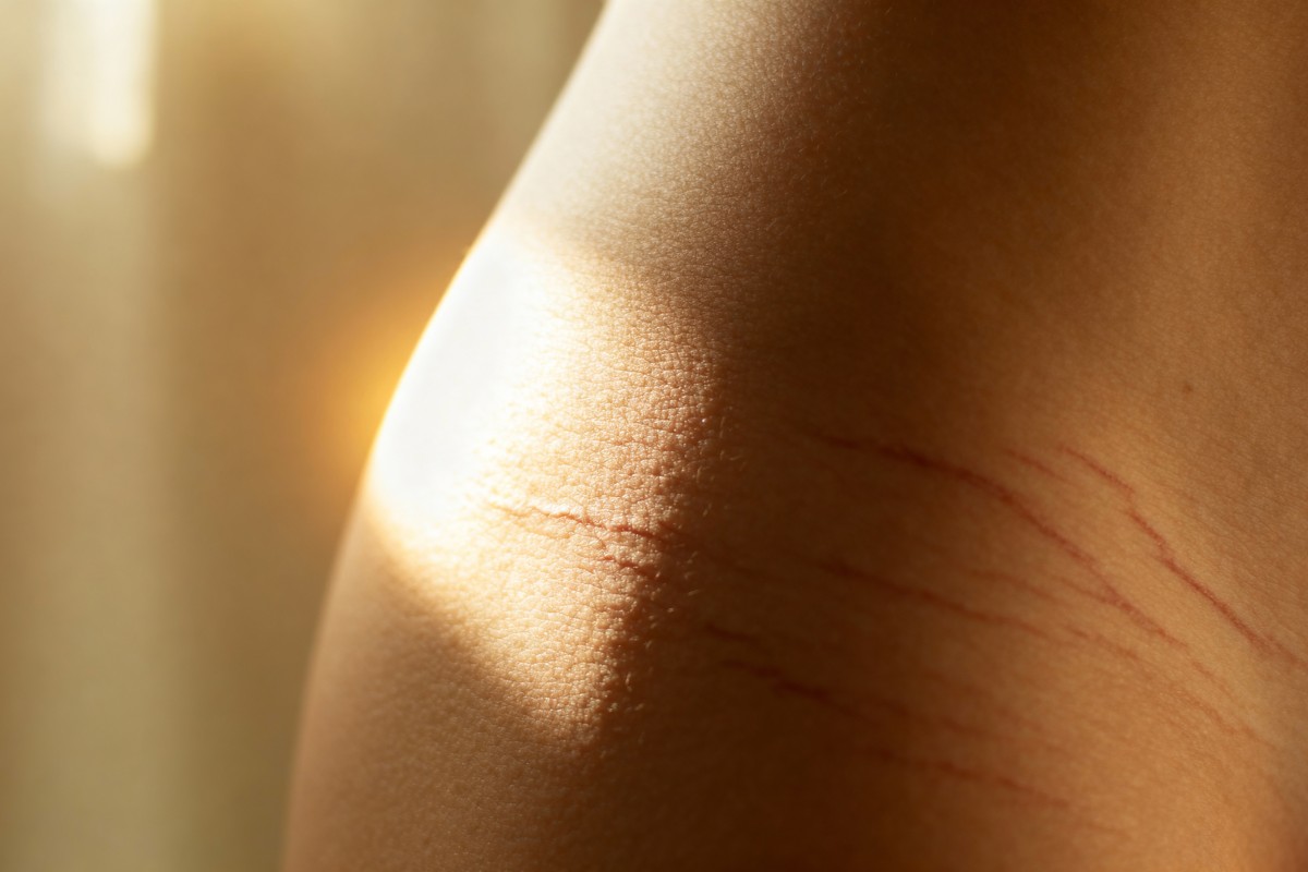 Sublime Aesthetic Stretch Marks